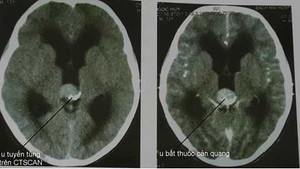 U tuyến tùng, cẩn thận nhầm bệnh tiêu hóa mà tử vong