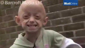 Cô bé 11 tuổi có khuôn mặt như bà lão 80