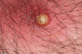 Bị 20 con giòi lúc nhúc dưới da sau chuyến đi Châu Phi