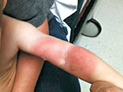 Bỏng tay cũng sẽ được lĩnh bảo hiểm