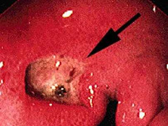 Thủ phạm gây bệnh loét dạ dày, tá tràng