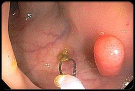 Đừng để tử vong vì u đại tràng