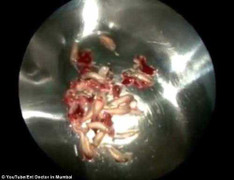 50 con giòi đục khoét mũi