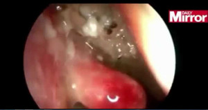 Rùng mình 50 con giòi làm tổ trong mũi người đàn ông