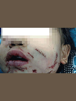 Chó tấn công bé 8 tuổi trông thương tâm thế này