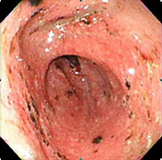 Giúp dân công sở thoát nỗi ám ảnh viêm loét dạ dày