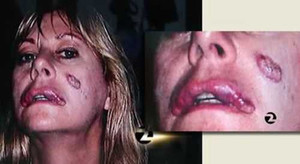 Những ca thẩm mỹ hỏng khiến nạn nhân không dám soi gương