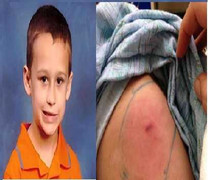 Bị nhện cắn, bé 5 tuổi chia xa cõi đời