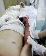 'Hóa điên' đánh nứt sọ bạn nhậu