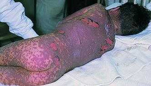 Tự ý mua thuốc uống khi ho, nguy hiểm tính mạng thế nào?