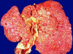 Tại sao người Việt 'chết mòn' vì ung thư?