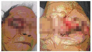 Cận cảnh giòi lúc nhúc trong mắt