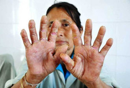 'Bệnh lạ' tái xuất ở Quảng Ngãi