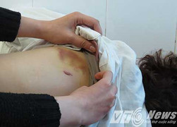 Đến đòi nợ, bị đánh hội đồng phải nhập viện tâm thần