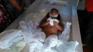 Bị cá ăn thịt rỉa nát chân, cô bé tử vong