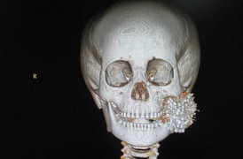 Bị găm hơn 300 viên đạn vào mặt, cậu bé Trung Quốc vẫn sống sót