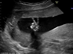 Thai nhi biết ‘tạo dáng chữ V’ trong bụng mẹ