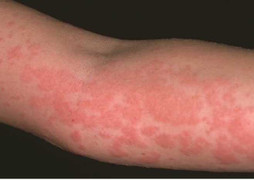 Đối phó với bệnh nổi mề đay khi trời lạnh