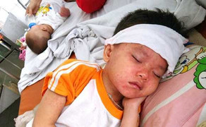 Cách phòng chống bệnh sởi trong mùa Đông Xuân