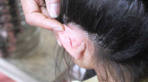 Cô giáo mầm non kéo tai làm trẻ bị thương