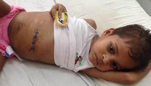 Búi tóc 'khủng' dài tới 1,2m trong dạ dày bé trai 4 tuổi