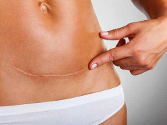 Muốn sẹo mờ nhanh, làm thế nào?