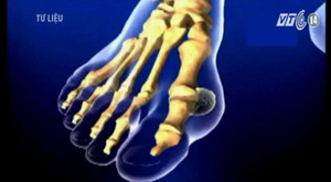 Giảm đau nhức xương khớp bằng kinh nghiệm dân gian