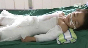 Xử trí khi trẻ bị bỏng