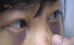 Mâu thuẫn nhỏ, nữ sinh lớp 10 bị đánh hội đồng đến đa chấn thương