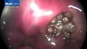 Clip: Bác sỹ gắp 100 con giòi trong mũi bệnh nhân