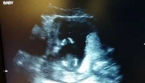 Clip thai nhi 14 tuần tuổi vỗ tay khi nghe mẹ hát gây sốt trên mạng