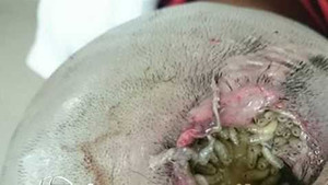 Ổ mủ vỡ, giòi to bằng đầu đũa 'đào hầm' trên đầu