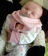 Đau lòng bé sơ sinh không có mắt