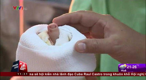 Clip: Tái tạo thành công ngón tay từ ngón chân bệnh nhân ở TP.HCM