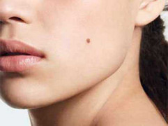 Dấu hiệu của bệnh ung thư da ai cũng nên biết