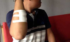 Trộm dùng dao có máu chứa virus HIV rạch tay hiệp sỹ bắt cướp