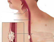 Quý ông hút thuốc lá, uống rượu: Cẩn thận với ung thư này