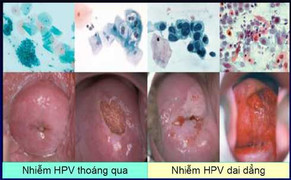 Ung thư cổ tử cung tấn công phụ nữ trẻ