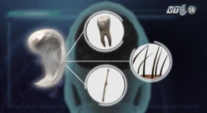 Kỳ lạ một phụ nữ có phôi thai trong não