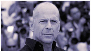 Hói là biểu hiện của nam tính?