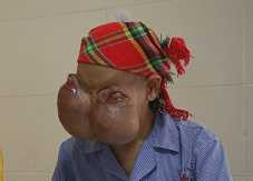 Người phụ nữ có đôi mắt như sắp nổ tung giờ ra sao?