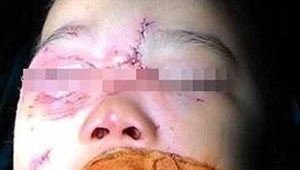 Bé 3 tuổi ở Hà Nội bị chó nhà cắn rách mặt