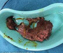 Bé 5 tuổi suýt chết vì thói quen ăn tóc