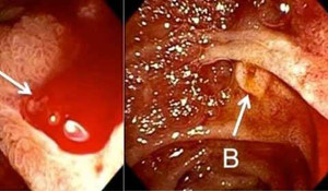 Chữa đau dạ dày không đúng cách: Hiểm họa khôn lường