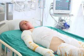 Nổ khí gas 4 người bỏng nặng: Nạn nhân kể lại phút kinh hoàng