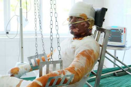 Nổ khí gas 4 người bỏng nặng: Lời cầu cứu trong đau đớn của nạn nhân