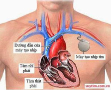 Sống chung với máy tạo nhịp tim
