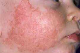 Lời khuyên vàng điều trị viêm da cơ địa