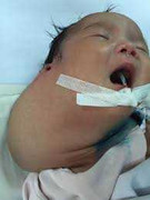 Cứu sống bé 15 ngày tuổi bị bướu khổng lồ ở mặt