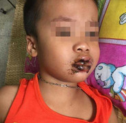 Ăn nhầm bột thông cống phải đi cấp cứu